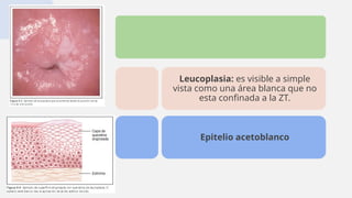 Leucoplasia: es visible a simple
vista como una área blanca que no
esta confinada a la ZT.
Epitelio acetoblanco
 