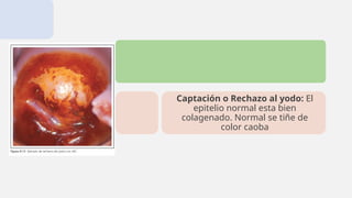 Captación o Rechazo al yodo: El
epitelio normal esta bien
colagenado. Normal se tiñe de
color caoba
 