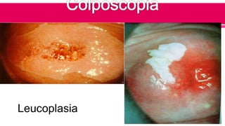 Leucoplasia
 