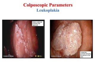 Dr Ayman Ewies - Colposcopic abnormal appearance | PDF