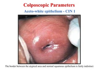 Dr Ayman Ewies - Colposcopic abnormal appearance | PDF