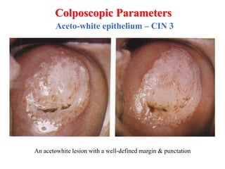 Dr Ayman Ewies - Colposcopic abnormal appearance | PDF