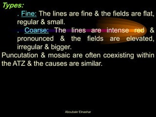 Types:
. Fine: The lines are fine & the fields are flat,
regular & small.
. Coarse: The lines are intense red &
pronounced & the fields are elevated,
irregular & bigger.
Puncutation & mosaic are often coexisting within
the ATZ & the causes are similar.
Aboubakr Elnashar
 