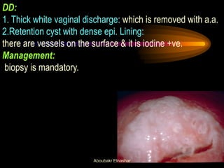DD:
1. Thick white vaginal discharge: which is removed with a.a.
2.Retention cyst with dense epi. Lining:
there are vessels on the surface & it is iodine +ve.
Management:
biopsy is mandatory.
Aboubakr Elnashar
 