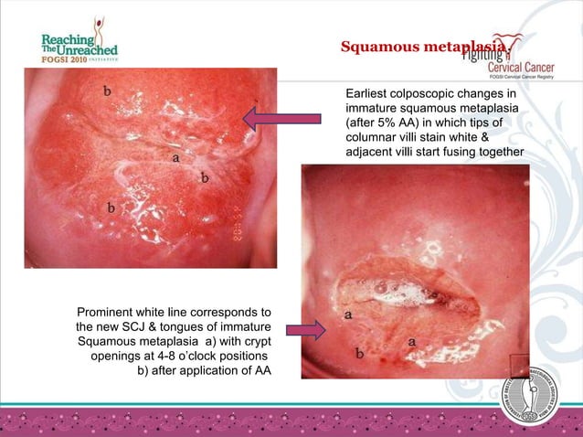 Colposcopy | PPT | Medical Health