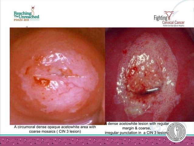 Colposcopy | PPT | Medical Health
