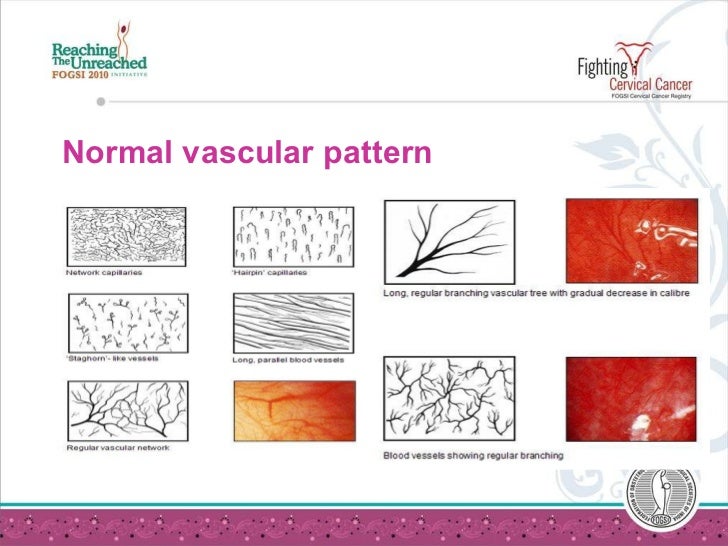Vascular Pattern Meaning | colposcopy Vascular Pattern Meaning | colposcopy