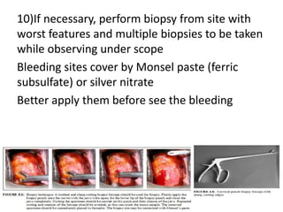 10)If necessary, perform biopsy from site with
worst features and multiple biopsies to be taken
while observing under scope
Bleeding sites cover by Monsel paste (ferric
subsulfate) or silver nitrate
Better apply them before see the bleeding
 