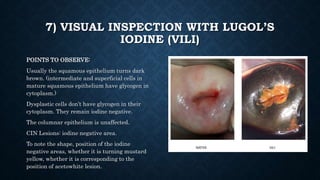 7) VISUAL INSPECTION WITH LUGOL’S
IODINE (VILI)
POINTS TO OBSERVE:
Usually the squamous epithelium turns dark
brown. (intermediate and superficial cells in
mature squamous epithelium have glycogen in
cytoplasm.)
Dysplastic cells don’t have glycogen in their
cytoplasm. They remain iodine negative.
The columnar epithelium is unaffected.
CIN Lesions: iodine negative area.
To note the shape, position of the iodine
negative areas, whether it is turning mustard
yellow, whether it is corresponding to the
position of acetowhite lesion.
 