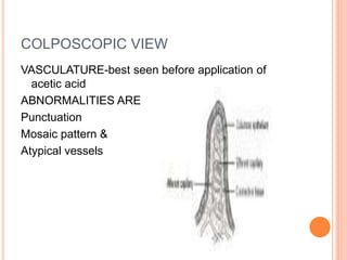 COLPOSCOPIC VIEW
VASCULATURE-best seen before application of
acetic acid
ABNORMALITIES ARE
Punctuation
Mosaic pattern &
Atypical vessels
 