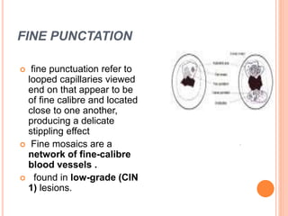FINE PUNCTATION
 fine punctuation refer to
looped capillaries viewed
end on that appear to be
of fine calibre and located
close to one another,
producing a delicate
stippling effect
 Fine mosaics are a
network of fine-calibre
blood vessels .
 found in low-grade (CIN
1) lesions.
 