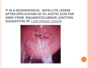 IT IS A GEOGRAPHICAL SATELLITE LESION
AFTER APPLICATION OF 5% ACETIC ACID FAR
AWAY FROM SQUAMOCOLUMNAR JUNCTION
SUGGESTIVE OF LOW GRADE LESION
 