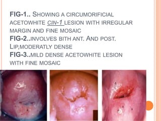 FIG-1.. SHOWING A CIRCUMORIFICIAL
ACETOWHITE CIN-1 LESION WITH IRREGULAR
MARGIN AND FINE MOSAIC
FIG-2..INVOLVES BITH ANT. AND POST.
LIP,MODERATLY DENSE
FIG-3..MILD DENSE ACETOWHITE LESION
WITH FINE MOSAIC
 