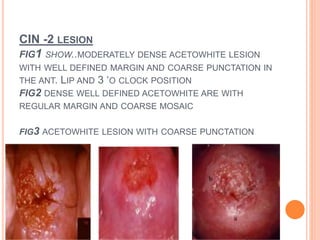 CIN -2 LESION
FIG1 SHOW..MODERATELY DENSE ACETOWHITE LESION
WITH WELL DEFINED MARGIN AND COARSE PUNCTATION IN
THE ANT. LIP AND 3 ‘O CLOCK POSITION
FIG2 DENSE WELL DEFINED ACETOWHITE ARE WITH
REGULAR MARGIN AND COARSE MOSAIC
FIG3 ACETOWHITE LESION WITH COARSE PUNCTATION
 