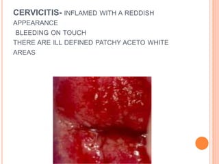 CERVICITIS- INFLAMED WITH A REDDISH
APPEARANCE
BLEEDING ON TOUCH
THERE ARE ILL DEFINED PATCHY ACETO WHITE
AREAS
 