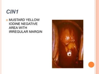 CIN1
 MUSTARD YELLOW
IODINE NEGATIVE
AREA WITH
IRREGULAR MARGIN
 