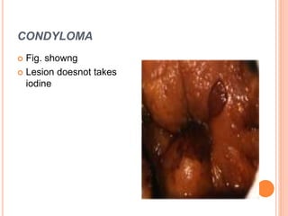 CONDYLOMA
 Fig. showng
 Lesion doesnot takes
iodine
 