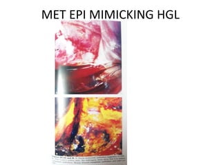 MET EPI MIMICKING HGL

 
