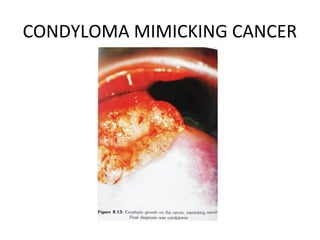 CONDYLOMA MIMICKING CANCER

 