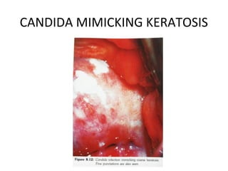 CANDIDA MIMICKING KERATOSIS

 