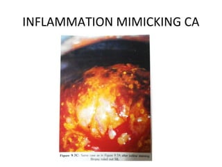 INFLAMMATION MIMICKING CA

 