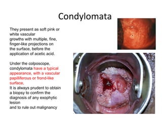 Condylomata
They present as soft pink or
white vascular
growths with multiple, fine,
finger-like projections on
the surface, before the
application of acetic acid.
Under the colposcope,
condylomata have a typical
appearance, with a vascular
papilliferous or frond-like
surface,
It is always prudent to obtain
a biopsy to confirm the
diagnosis of any exophytic
lesion
and to rule out malignancy

 