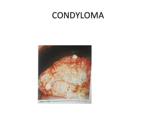 CONDYLOMA

 
