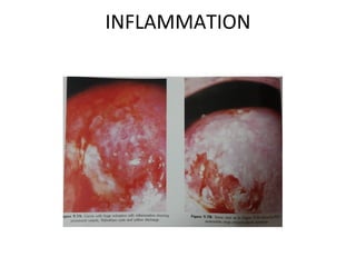 INFLAMMATION

 