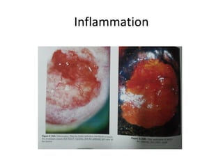 Inflammation

 