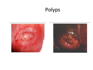 Polyps

 