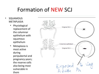 Formation of NEW SCJ
•

SQUAMOUS
METAPLASIA
• Physiological
replacement of
the columnar
epithelium with
squamous
epithelium
• Metaplasia is
most active
during
peripubertal and
pregnancy years;
the reserve cells
also being most
vulnerable in
them

 