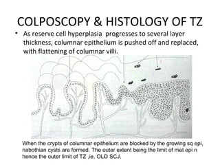 COLPOSCOPY & HISTOLOGY OF TZ

• As reserve cell hyperplasia progresses to several layer
thickness, columnar epithelium is pushed off and replaced,
with flattening of columnar villi.

When the crypts of columnar epithelium are blocked by the growing sq epi,
nabothian cysts are formed. The outer extent being the limit of met epi n
hence the outer limit of TZ ,ie, OLD SCJ.

 