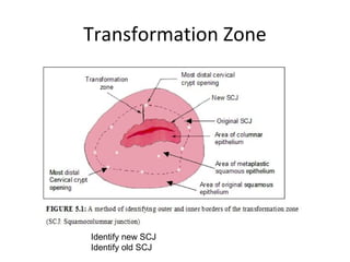 Transformation Zone

Identify new SCJ
Identify old SCJ

 