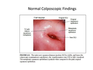 Normal Colposcopic Findings

 