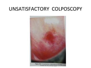 UNSATISFACTORY COLPOSCOPY

 