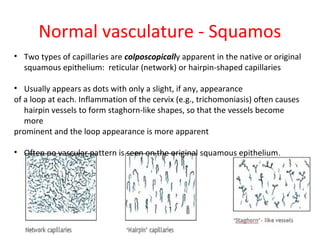 Normal vasculature - Squamos
• Two types of capillaries are colposcopically apparent in the native or original
squamous epithelium: reticular (network) or hairpin-shaped capillaries
• Usually appears as dots with only a slight, if any, appearance
of a loop at each. Inflammation of the cervix (e.g., trichomoniasis) often causes
hairpin vessels to form staghorn-like shapes, so that the vessels become
more
prominent and the loop appearance is more apparent
• Often no vascular pattern is seen on the original squamous epithelium .

 