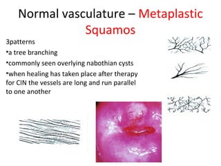 Normal vasculature – Metaplastic
Squamos

3patterns
•a tree branching
•commonly seen overlying nabothian cysts
•when healing has taken place after therapy
for CIN the vessels are long and run parallel
to one another

 