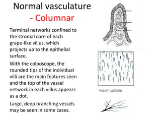 Normal vasculature
- Columnar
Terminal networks confined to
the stromal core of each
grape-like villus, which
projects up to the epithelial
surface.
With the colposcope, the
rounded tips of the individual
villi are the main features seen
and the top of the vessel
network in each villus appears
as a dot.
Large, deep branching vessels
may be seen in some cases.

 