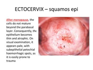 ECTOCERVIX – squamos epi
After menopause, the
cells do not mature
beyond the parabasal
layer. Consequently, the
epithelium becomes
thin and atrophic. On
visual examination, it
appears pale, with
subepithelial petechial
haemorrhagic spots, as
it is easily prone to
trauma

 