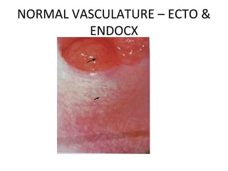 NORMAL VASCULATURE – ECTO &
ENDOCX

 
