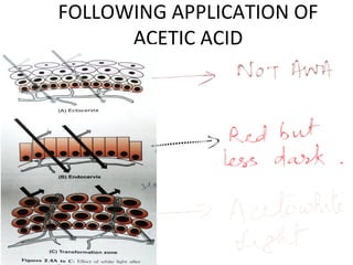 FOLLOWING APPLICATION OF
ACETIC ACID

 