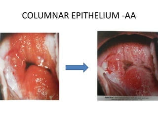 COLUMNAR EPITHELIUM -AA

 