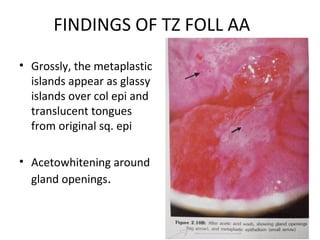 FINDINGS OF TZ FOLL AA
• Grossly, the metaplastic
islands appear as glassy
islands over col epi and
translucent tongues
from original sq. epi
• Acetowhitening around
gland openings.

 