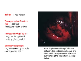 Col epi – I neg yellow
Squamos native & mature
met – I positive
mahogony / dark brown
Immature metaplasia –
Ineg / partial uptake if
partially glycogenated
Endocervical polyps – I
neg as covered by col epi /
immature met epi

After application of Lugol’s iodine
solution, the endocervical polyp and
the immature squamous metaplasia
surrounding the os partially take up
iodine

 