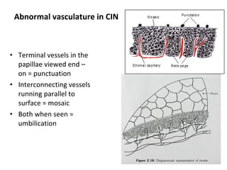 Abnormal vasculature in CIN

• Terminal vessels in the
papillae viewed end –
on = punctuation
• Interconnecting vessels
running parallel to
surface = mosaic
• Both when seen =
umbilication

 