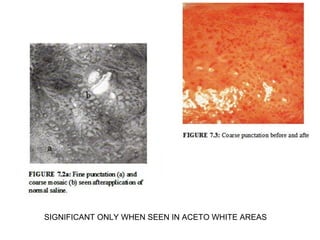 SIGNIFICANT ONLY WHEN SEEN IN ACETO WHITE AREAS

 