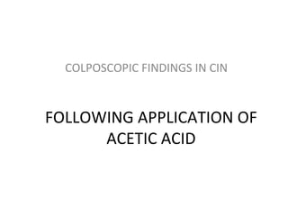 COLPOSCOPIC FINDINGS IN CIN

FOLLOWING APPLICATION OF
ACETIC ACID

 