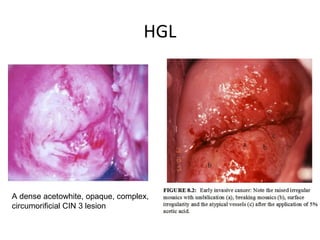 HGL

A dense acetowhite, opaque, complex,
circumorificial CIN 3 lesion

 