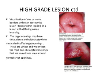 HIGH GRADE LESION ctd
 Visualization of one or more
borders within an acetowhite
lesion (‘lesion within lesion’) or a
lesion with differing colour
intensity.
 The crypt openings may have
thick, dense and wide acetowhite
rims called cuffed crypt openings .
These are whiter and wider than
the mild, line-like acetowhite rings
that are sometimes seen around
normal crypt openings.

 