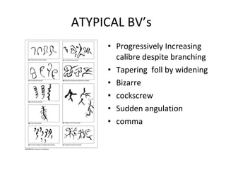 ATYPICAL BV’s
• Progressively Increasing
calibre despite branching
• Tapering foll by widening
• Bizarre
• cockscrew
• Sudden angulation
• comma

 